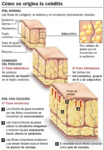 Por que tengo celulitis 2